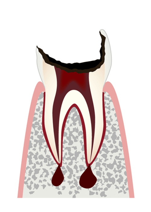 歯の大部分が失われた歯